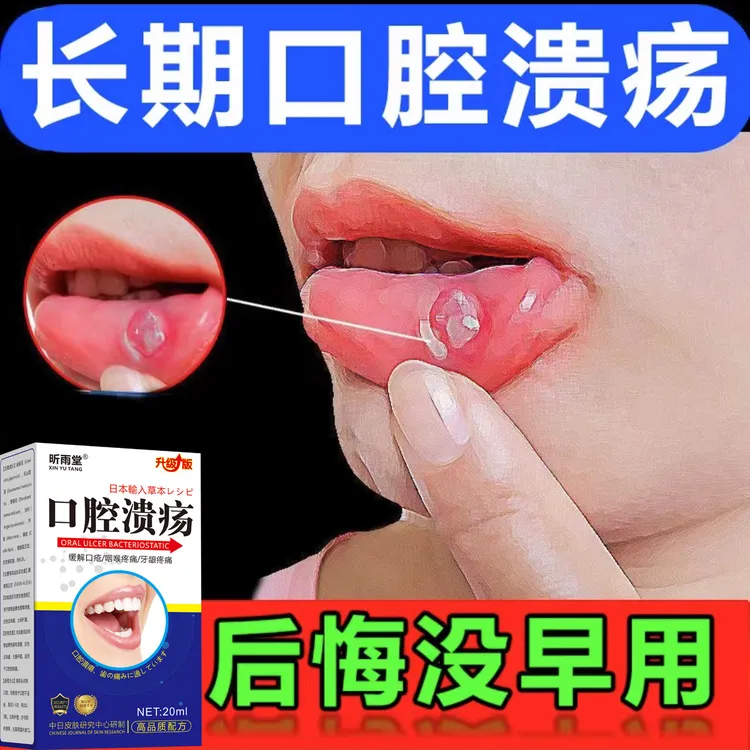 口腔溃疡烂嘴喷剂口舌生起泡嘴舌尖专用草本口喷