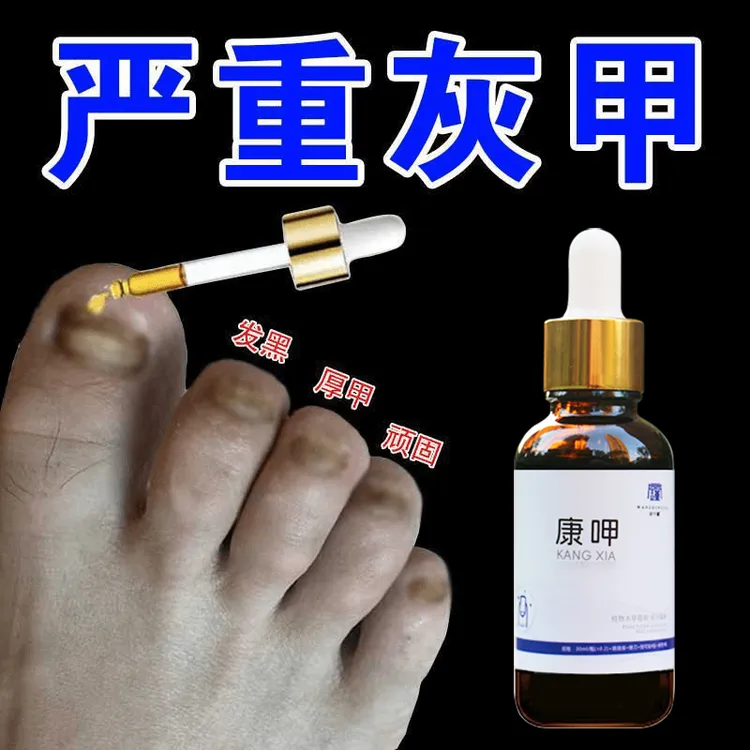 【严重症状】恢呷专用抑菌液灰手指脚趾甲特亮甲坏正品修指甲抑菌液