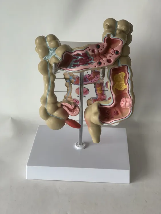 人体结肠息肉病理肛肠模型大肠病理教学模型内脏消化系统演示教具