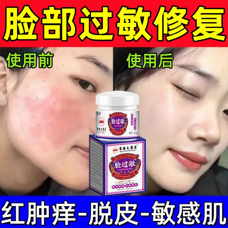 香港脸过敏干燥起皮起疙瘩发红痒皮肤过敏激素脸过敏修复止痒膏霜