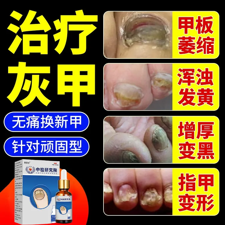 灰趾指甲灰脚趾甲专用抑菌液正品水凤仙花指甲手指脚趾甲变灰色