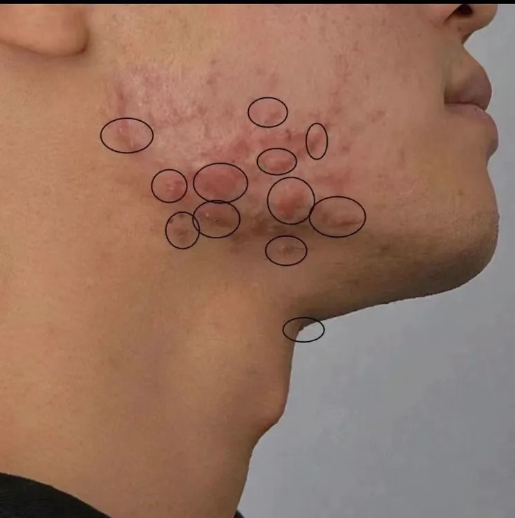 腮边痘下巴淋巴痘硬块痘下巴脸颊两侧痘脖子痘涂抹湿毒清抑菌软膏