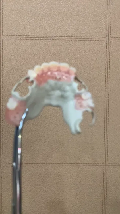 活动义齿匹克支架超轻假牙