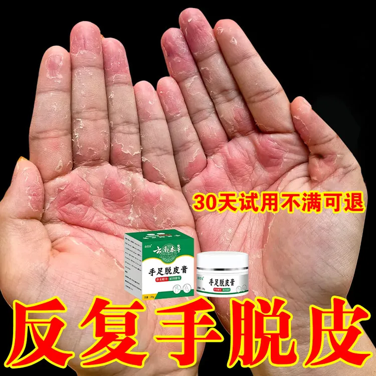 手足脱皮膏鹅掌风干裂脱皮手痒手裂口手足霜手足软膏脚干抑菌软膏