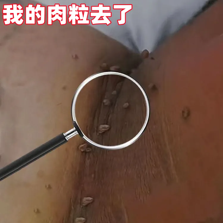 【小肉粒专用】正品云南白草克尤膏脖子手足腋下丝状扁平肉刺深层