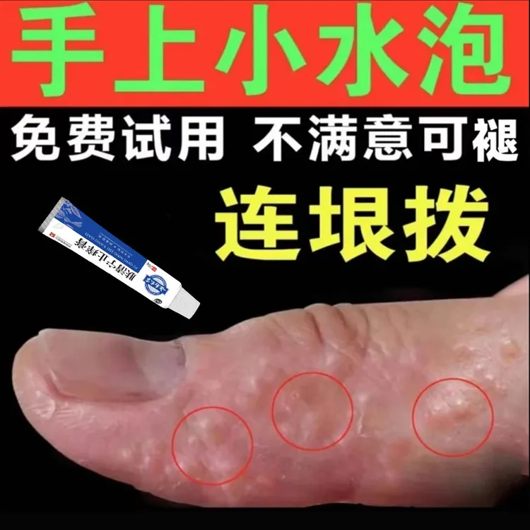 手指长小水泡手部痒手指开裂手指脱皮专用手足起汗泡克星抑菌软膏