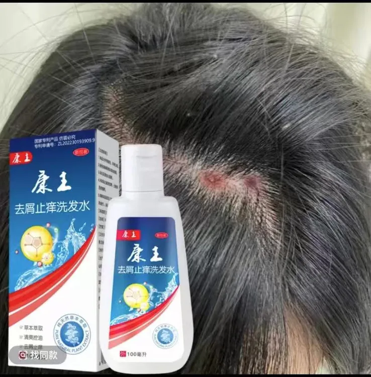 去屑止痒洗发水严重大块头皮屑头痒除螨毛囊控油康主专用洗发露