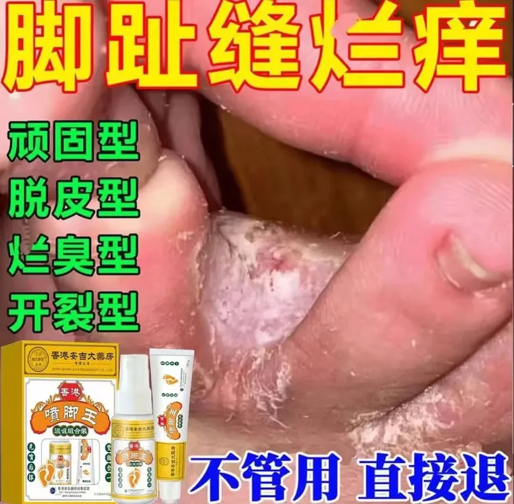 香港喷䐚王腳脱皮腳殠腳痒出汗起水泡止痒抑菌止痒一喷一抹