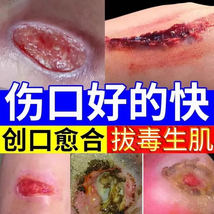 云南金创灵祛腐生肌粉老烂腿糖尿足褥疮等伤口快速愈合
