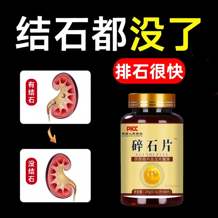 【央企力荐✅】碎石片排石化石溶石去输尿管胆囊胆石肾结石快速排石