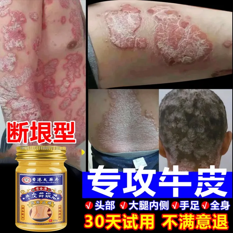 【牛皮藓克星】全身红点痒皮肤止痒去顽固根手足体股廯正品止痒乳膏