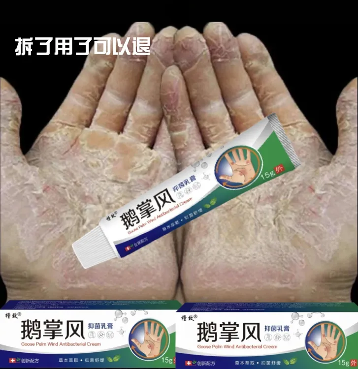 鹅掌风手部干裂脱皮手痒手裂口子手足起泡开口开裂起皮草本抑菌膏