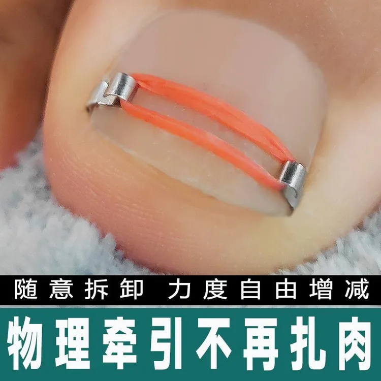 正甲扣甲沟嵌甲矫正器正甲贴指甲卷甲往肉里长脚指甲扎肉纠正炎垫