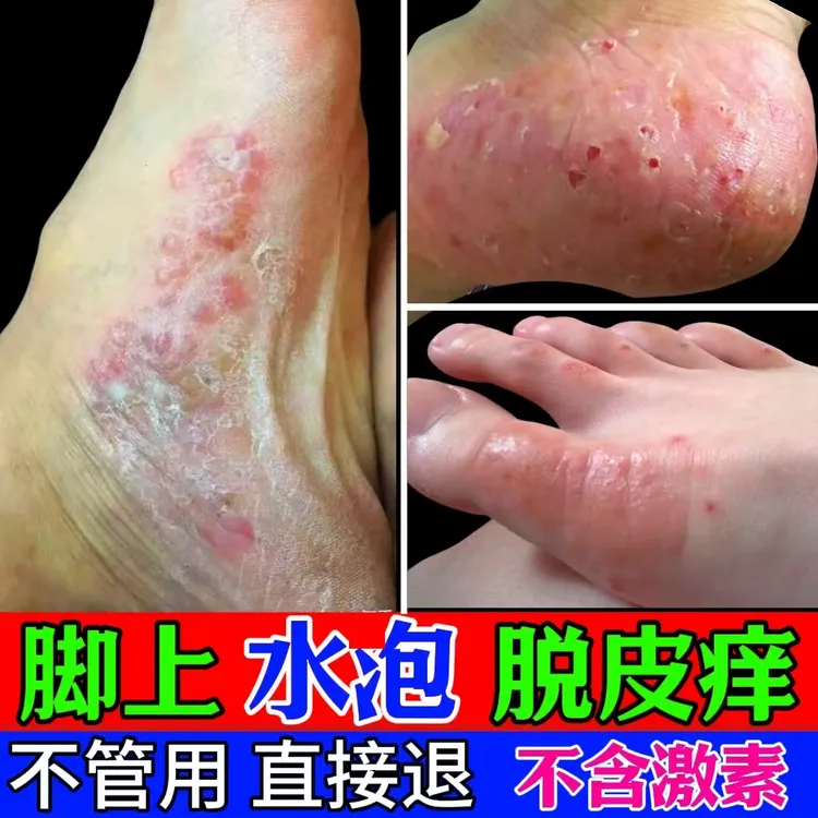  脚底脚上起小水臭痒泡脱皮真菌王脚臭止痒抑菌软膏喷雾剂