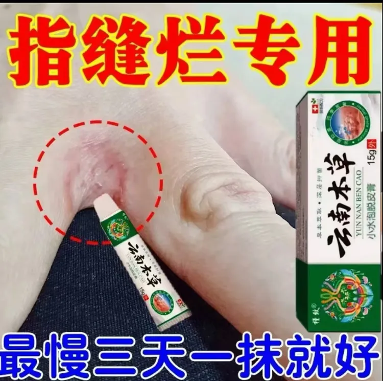 手指缝溃烂药膏洗洁精过敏烂手丫专用指间糜烂开裂起水泡泛红瘙痒