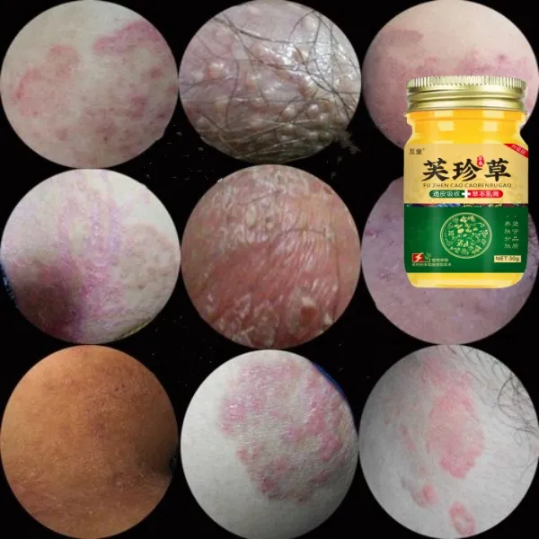 大腿内侧痒芙珍草胳膊手足家中常备草本萃取外用涂抹皮肤止痒膏