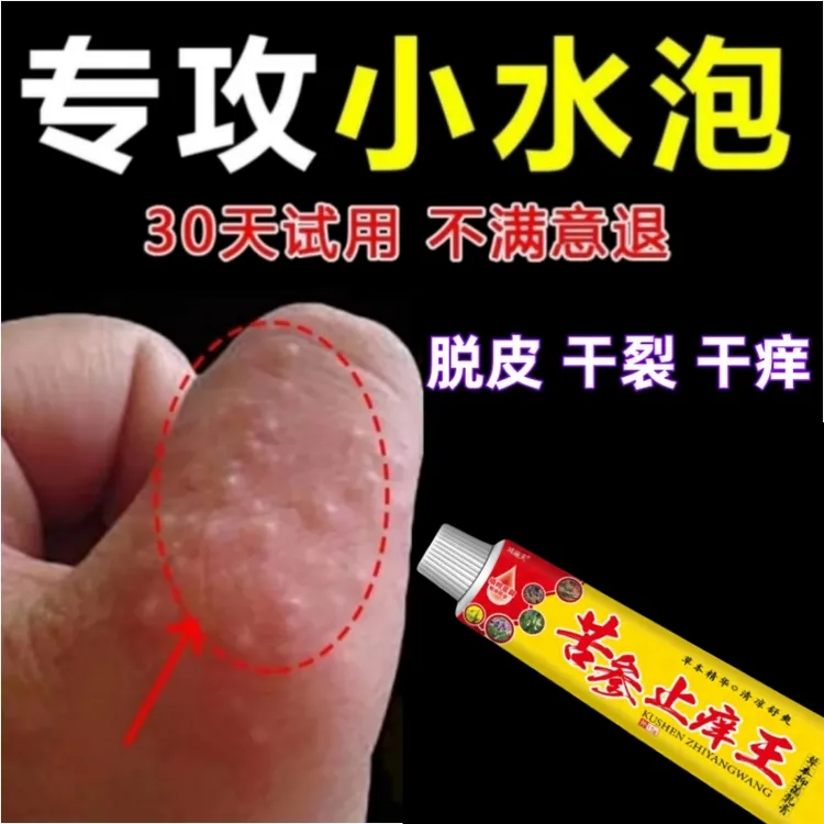 【苦参止痒王】手指长小水泡手部痒开裂脱皮手足起汗泡止痒正品软膏