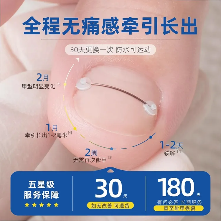 甲沟矫正神器指甲矫正器嵌甲卷甲正甲垫片脚趾甲往肉里长炎镍钛丝