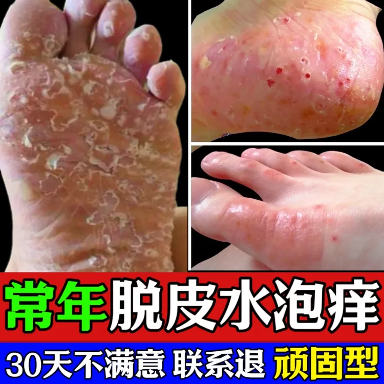 脚底脚上起小水痒泡又脱皮真菌王脚臭止痒抑菌软膏特效神器克星正