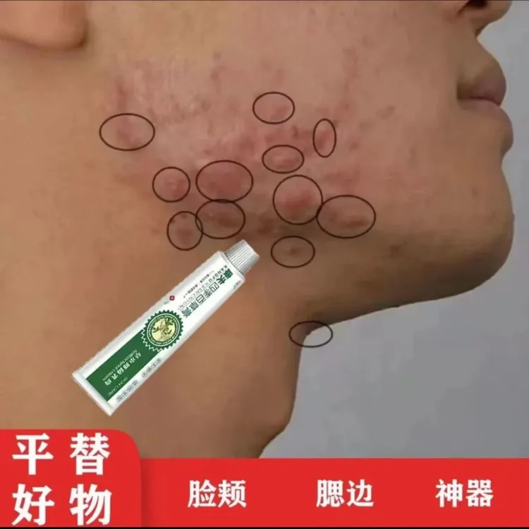 腮边痘下巴痘硬块痘痘下巴脸颊两侧脖子周围痘痘草本萃取抑菌软膏