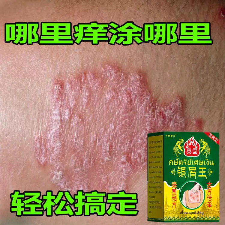 【泰国秘方】全身牛皮/银屑/手足头体股大腿内侧止痒软膏药专用肤癣