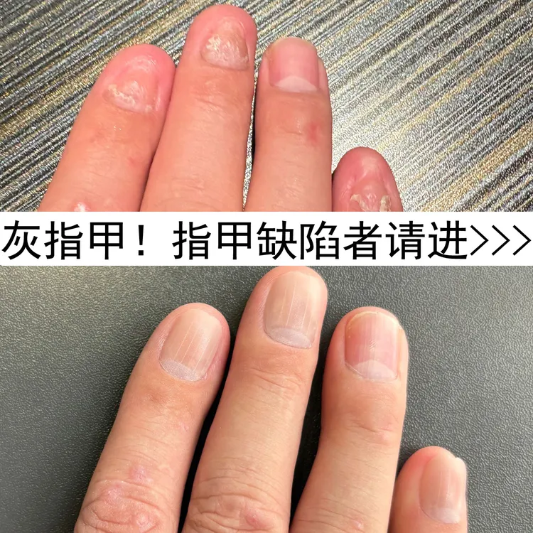 灰指甲男士仿真指甲假指甲贴片缺陷穿戴可拆卸男脚趾仿真指甲