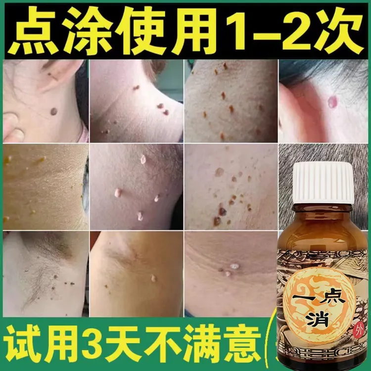 手上脖子全身长疙瘩刺瘊子全身肉刺球手足凸起寻常疙瘩温和外用液