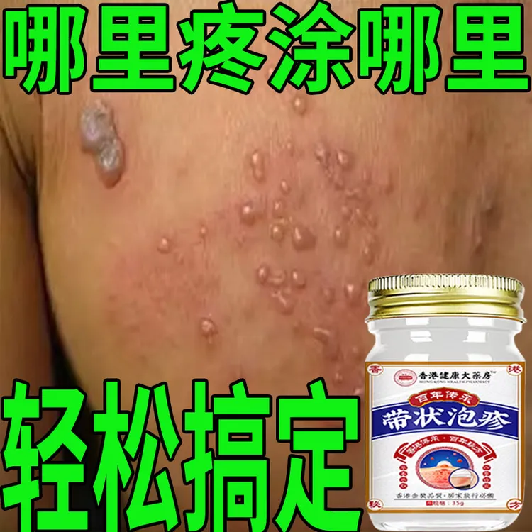 带状泡疹后遗神经痛蛇盘疮膏蛇盘清宝带状疱疹后遗症神经痛特效药