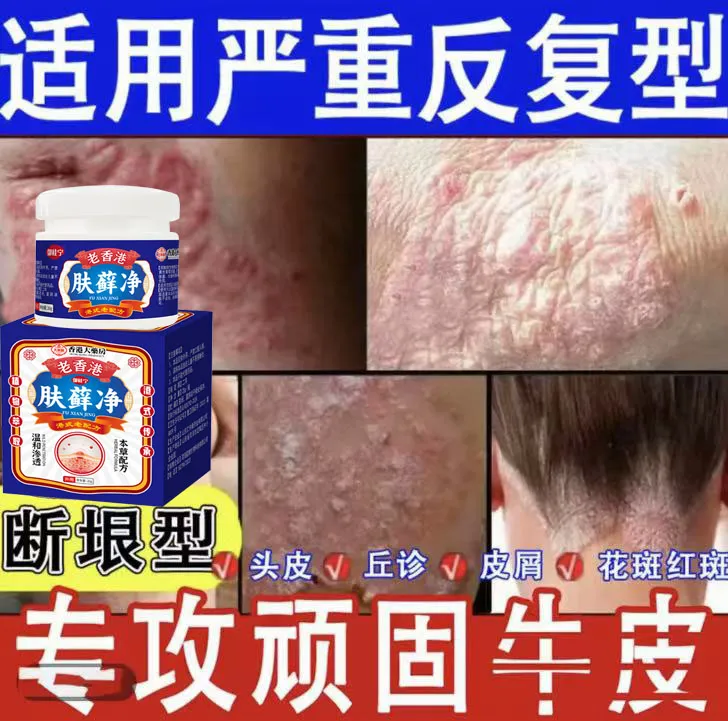 【香港肤藓王】全身牛/皮/银/屑/手足头体股大腿内侧止痒藓膏药专用