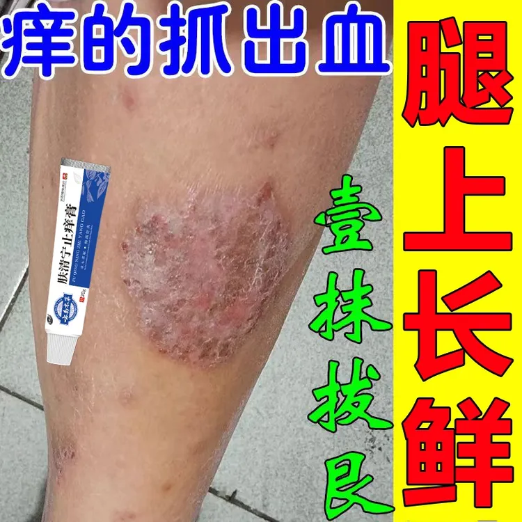 腿部发痒有鳞屑毛囊感染堵塞起疙瘩肿胀结痂专用草本植萃抑菌乳膏