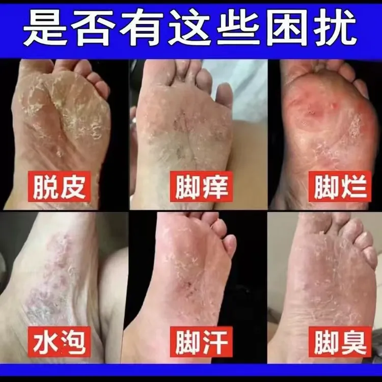 脚痒脚臭喷雾剂止痒神器脚底开裂起皮泡脱皮脚丫趾缝烂止痒膏水