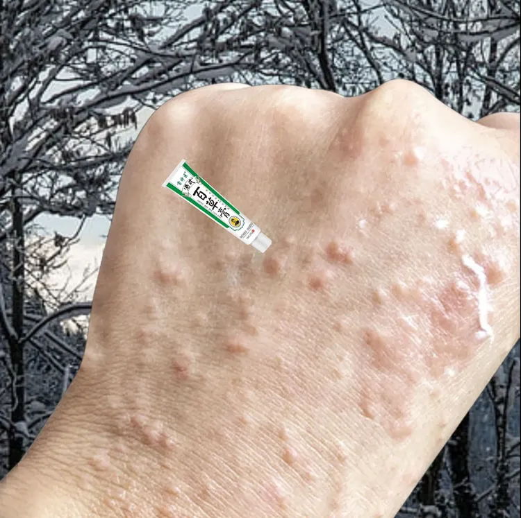 手背痒手背上起小红点疙瘩瘙痒手上皮肤长痘痘止痒抑菌膏草本膏