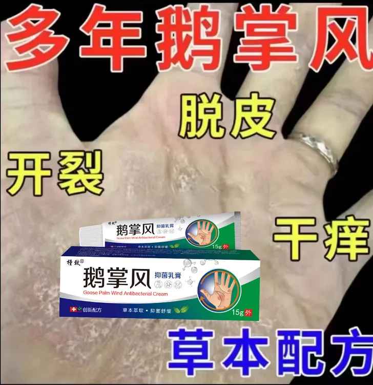 手足脱皮膏鹅掌风干裂脱皮手痒手裂口手足霜手足软膏脚干抑菌软膏