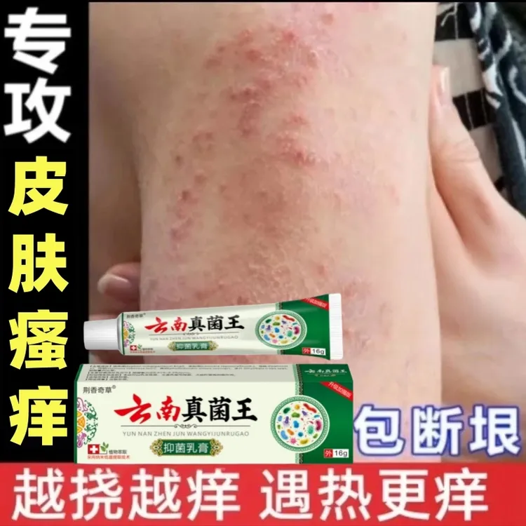 【极速发货】云南真菌王有效止痒皮肤干燥红痒外用全身干痒止痒膏