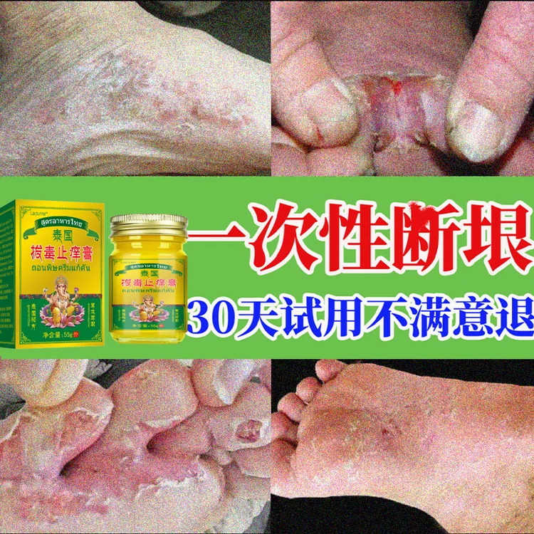 【踋汽膏】脚起小水萢止痒膏脚趾缝烂痒脱皮抑菌开裂克星痒专用软膏