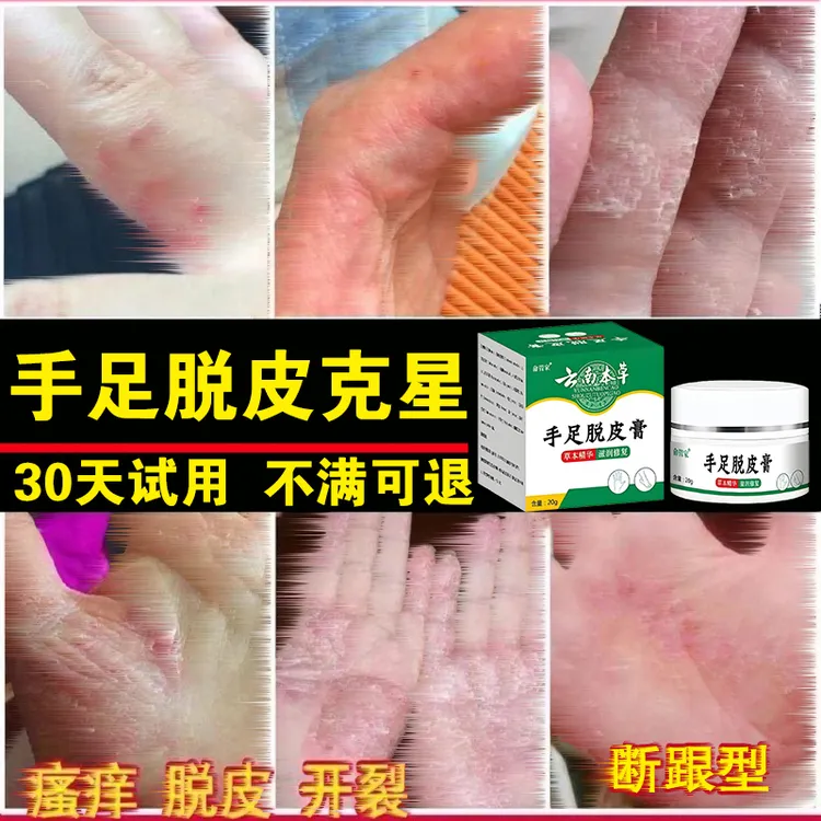 手足脱皮膏干裂鹅掌风脱皮手痒手裂口手足霜手足软膏脚干抑菌软膏