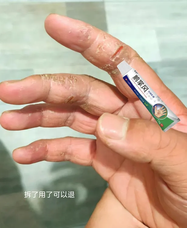 鹅掌风手部干裂脱皮手痒手裂口子手足起泡开口开裂起皮草本抑菌膏