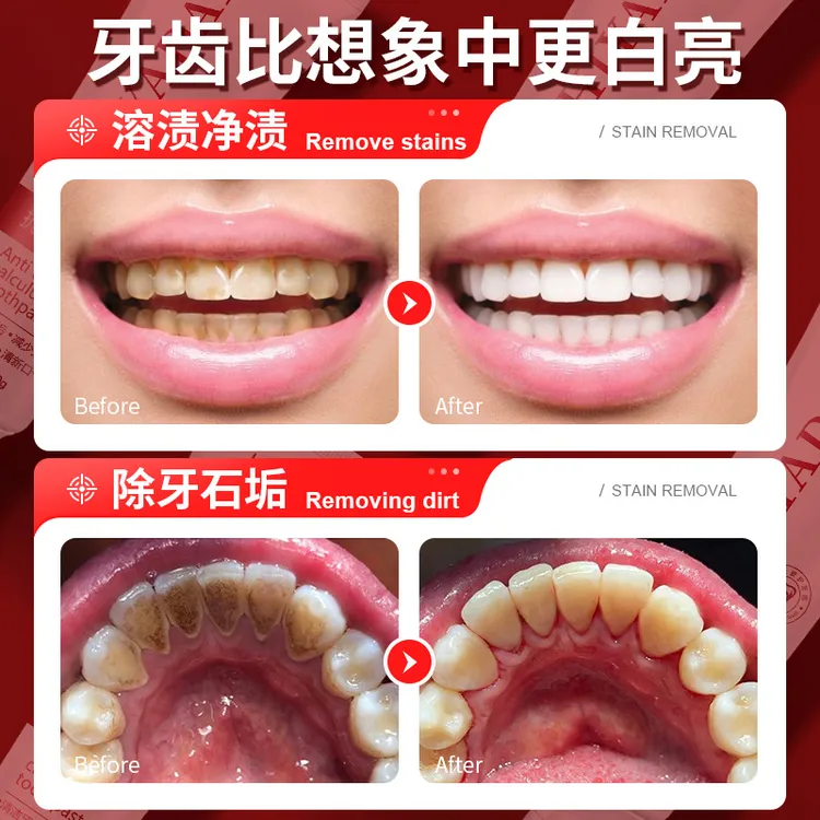 去牙结石溶解牙石专用洗牙齿污垢美白去除黄牙牙渍牙垢速效牙膏