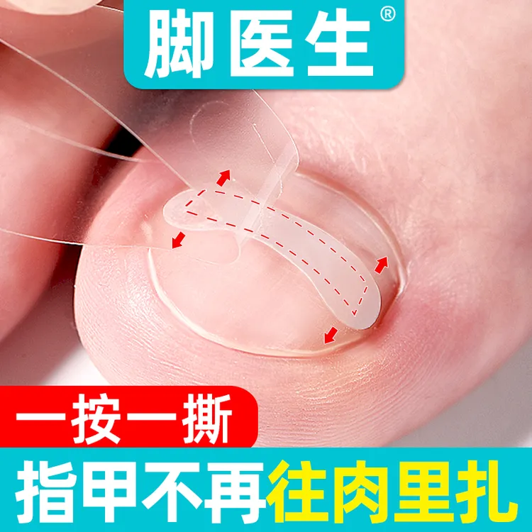 JIAOYISHENG/脚医生脚趾正甲贴片防水嵌甲甲沟炎矫正指甲长肉里