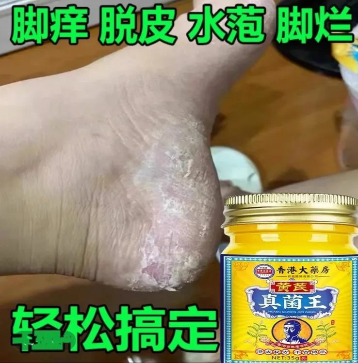 【正品保证】香港真菌王植物草本萃取适用于手脚真菌皮肤外用抑菌膏