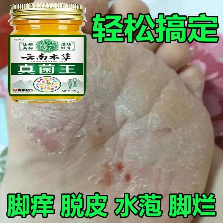 云南真菌王脚臭脚痒脱皮起水萢脚后跟干裂趾缝痒膝肘贴草本抑菌膏