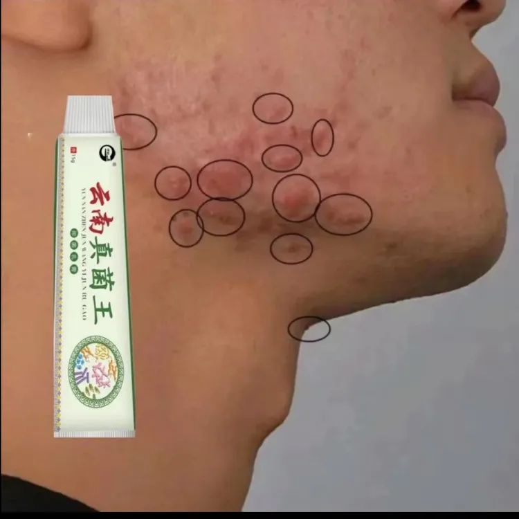 腮边痘淋巴祛痘膏下巴脸颊两侧脖子长痘硬块疙瘩疮脓包专用抑菌膏