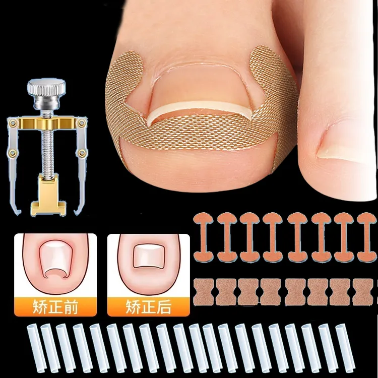 正甲贴甲沟炎矫正神器嵌甲专用脚指甲往肉里纠正趾甲扎肉隔离垫片