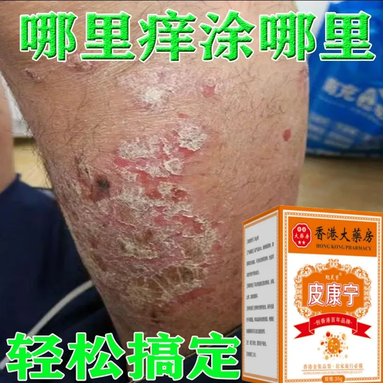 【香港皮康宁】牛皮肤银屑膏头藓顽固手足股止痒大腿内侧痒全身可用