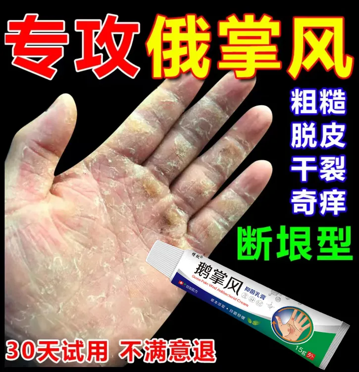 鹅掌风手部干裂脱皮手痒手裂口子手足起泡开口开裂起皮草本抑菌膏
