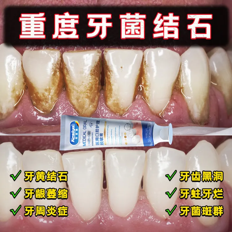  科思雅医用口腔护理脱敏膏ksy2