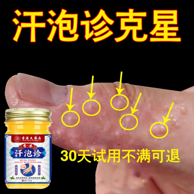 汗泡诊克星手上起小水泡止痒膏脱皮抑菌手指缝痒干裂专用草本乳膏