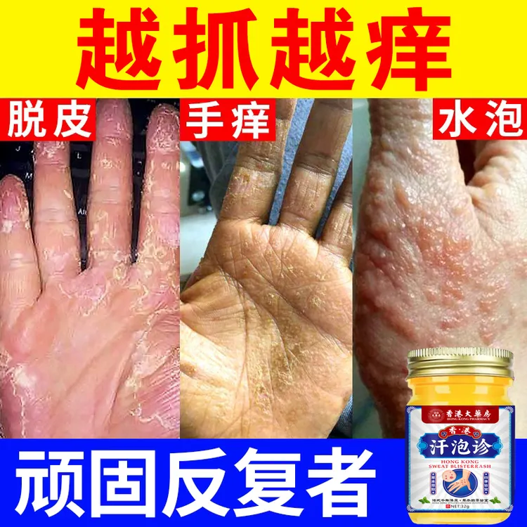 汗珍泡手上起小水泡止痒膏脱皮抑菌克星手指缝痒干裂专用草本乳膏