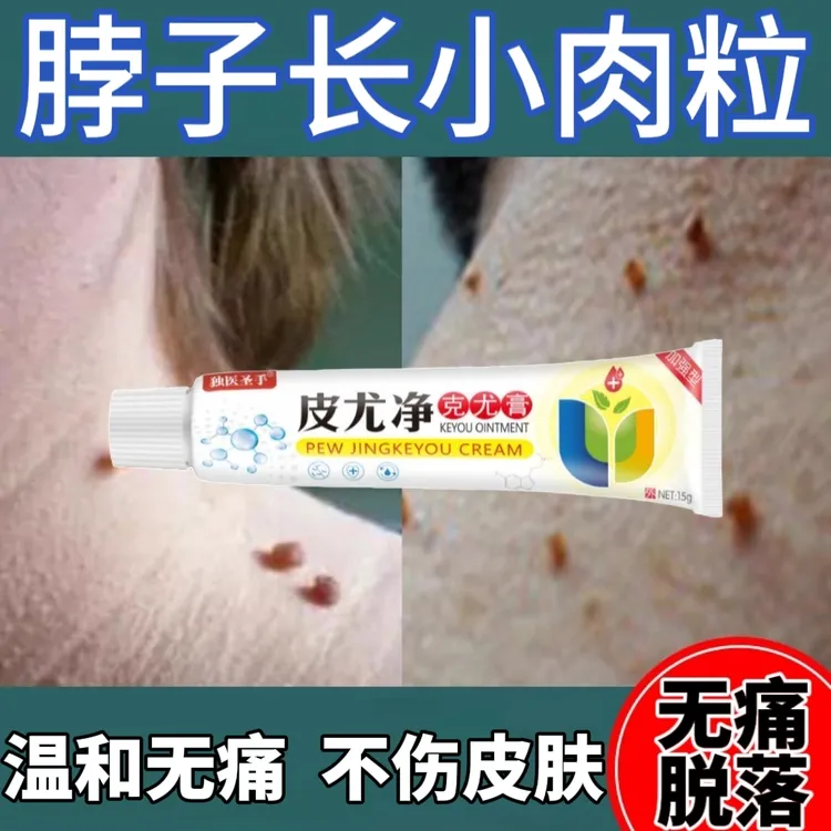去除脖子手足腋下肉小疙瘩粒全身适用草本抑菌涂抹膏