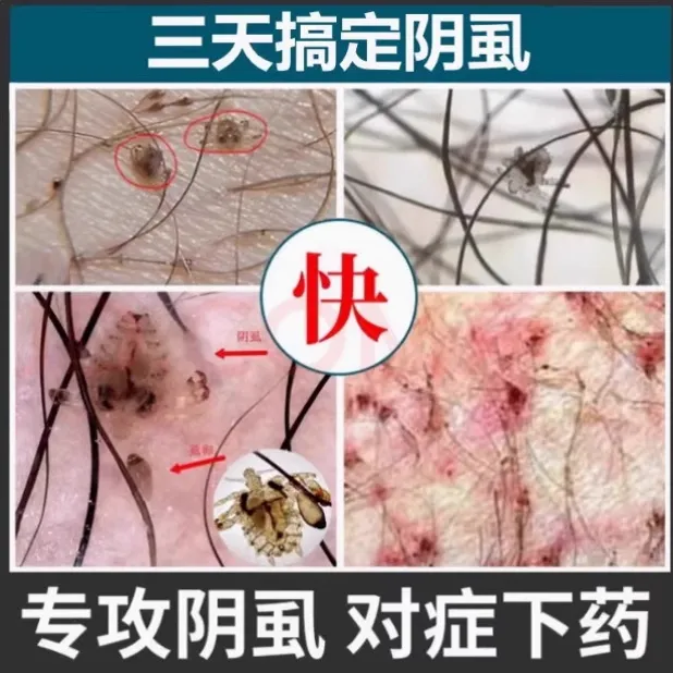 正品百部酊喷剂虱子虱卵一扫光不伤发肤阴虱卵怎么去除硫磺软膏